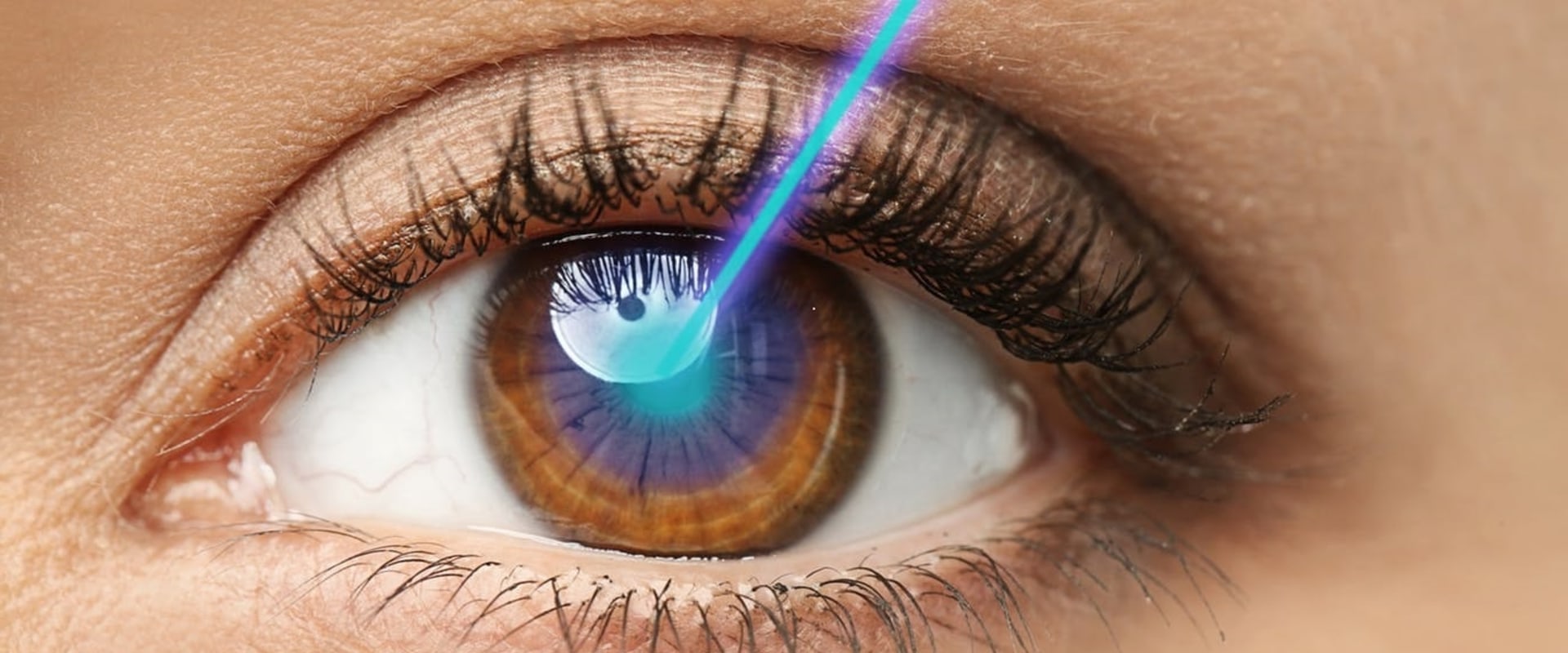 Can Overcorrection After LASIK Be Corrected?