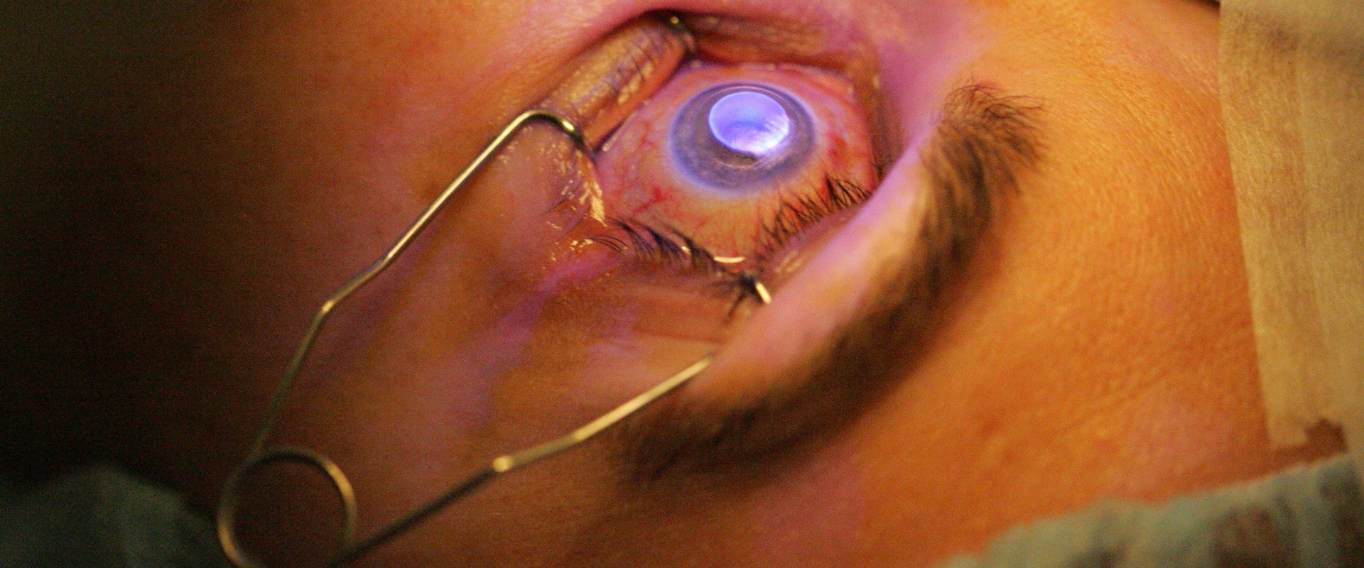 Is LASIK Surgery Painful? An Expert's Perspective