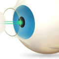 What Causes Undercorrection in LASIK Surgery?