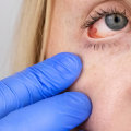 Can Glaucoma Patients Get PRK?