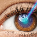 The Risks of Lasik Overcorrection: What You Need to Know