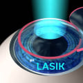LASIK vs PRK: Which Laser Eye Surgery is Right for You?