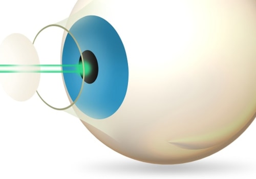 What Causes Undercorrection in LASIK Surgery?