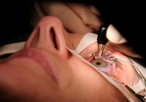 Is LASIK Surgery Worth It After 50?