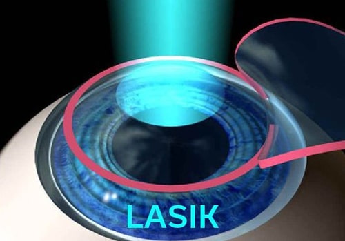 LASIK vs PRK: Which Laser Eye Surgery is Right for You?