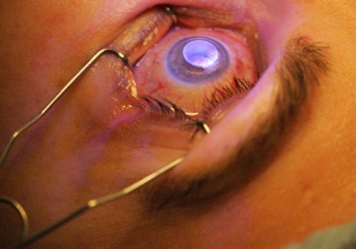 Is LASIK Surgery Painful? An Expert's Perspective